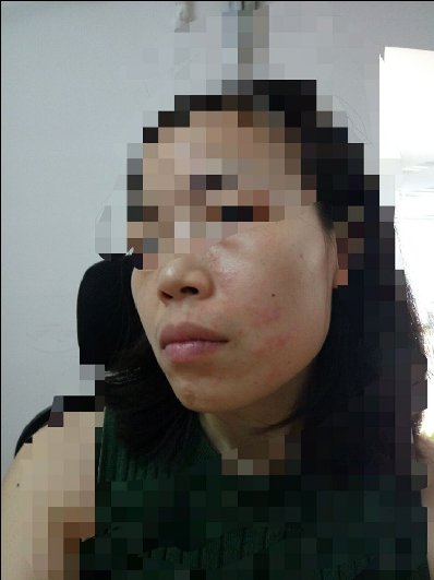 在天猫上购买的美即面膜使用后脸部大面积出红疹